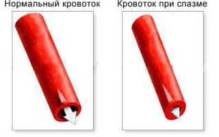 Церебральная ангиодистония сосудов головного мозга — причины, симптомы, лечение