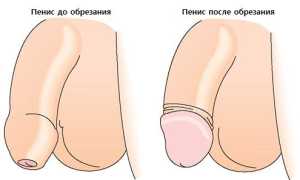 Нужно ли мужчинам делать обрезание