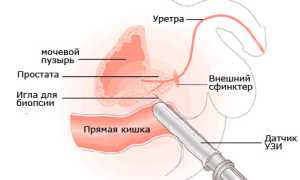Как делают УЗИ предстательной железы?