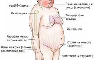 Болезнь Иценко — Кушинга