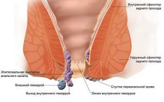 Факторы, признаки, лечение геморроя у мужчин