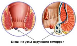 Лечение геморроя эффективными средствами
