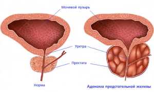 Как бороться с аденомой простаты?