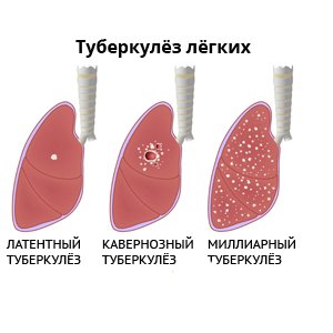 Стадии туберкулеза