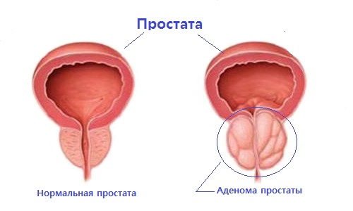 Аденома простаты