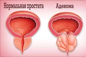 Аденома простаты