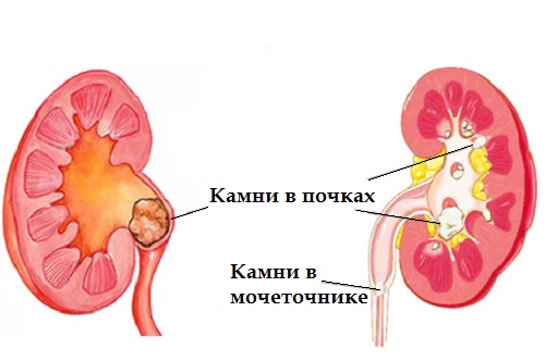 Kamni v pochkah