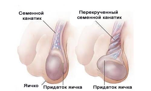 Perekrut levogo jaichka