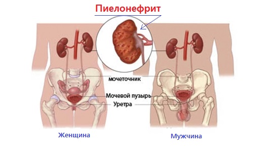 Pielonefrit u muzhchin