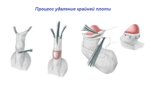 Process udalenie krajnej ploti