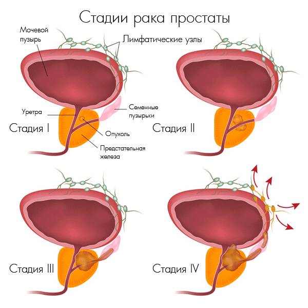 Стадии рака простаты