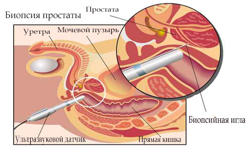 Shema biopsii predstatel'noj zhelezy