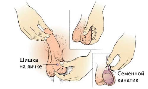 Появление шишки на яичке