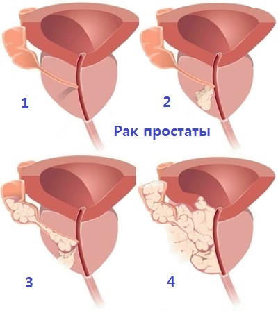 Рак прстаты