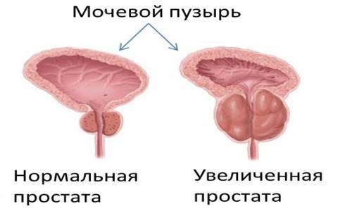 Увеличенная простата