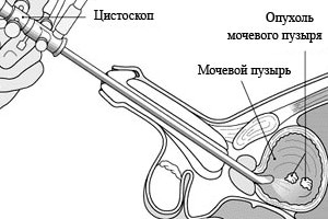Бужирование стриктуры