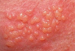 genital'nyj gerpes u muzhchin
