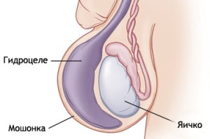 Признаки гидроцеле
