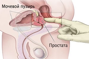 массаж предстательной железы