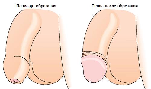 obrezanie