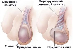 Перекрут железы