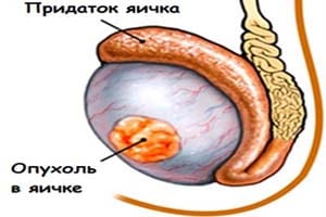 Рак яичка