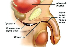 Стриктура уретры