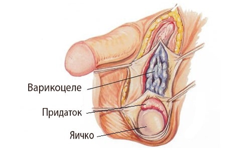 Варикоцеле левого яичка