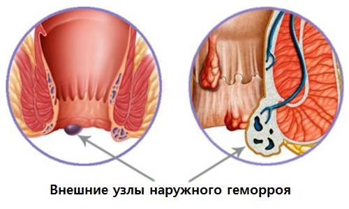 vneshnie uzly naruzhnogo gemorroja