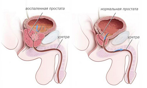 vospalenie prostaty